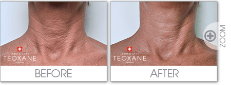neck chest