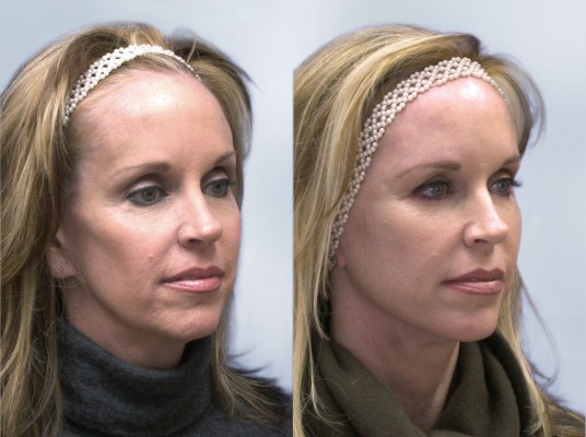 Sculptra before and after