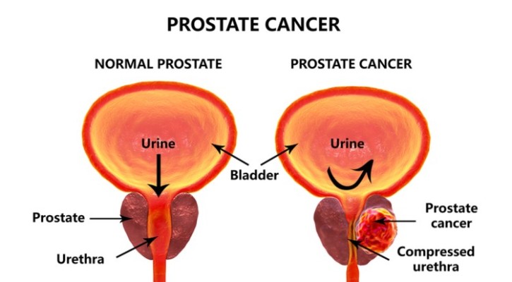 High-fat-diet-linked-to-prostate-cancer-spread_wrbm_large