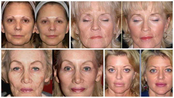 facelifts