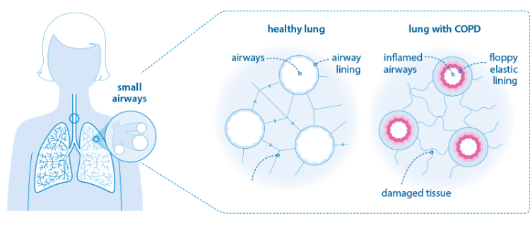 COPD airways graphic