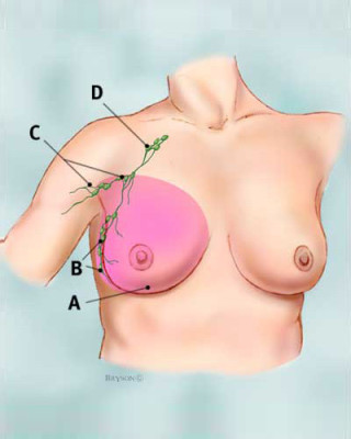 modified_radical_mastectomy_tcm8-326772