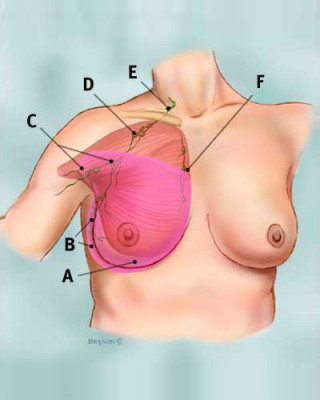 radical_mastectomy_tcm8-326804