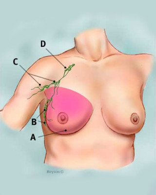 total_simple_mastectomy_tcm8-326810