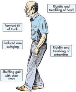 parkinsons-disease-symptoms-247x300