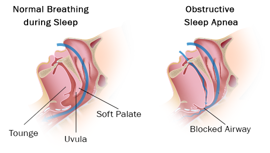 sleep-apnea_infographic_01